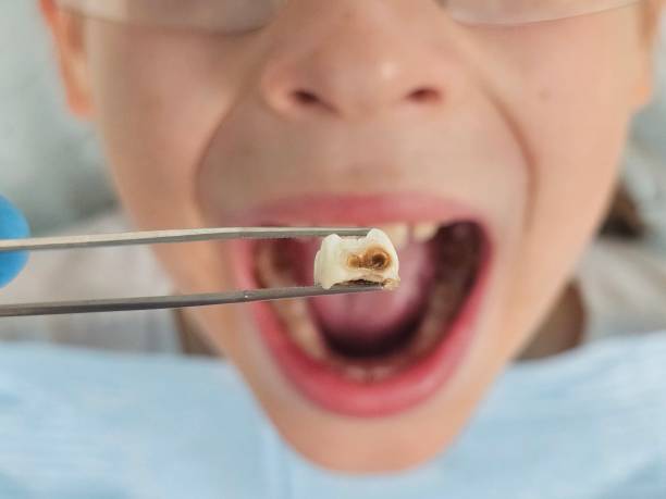Best Emergency Dentist for Lost Fillings or Crowns in Jacksonville, AL